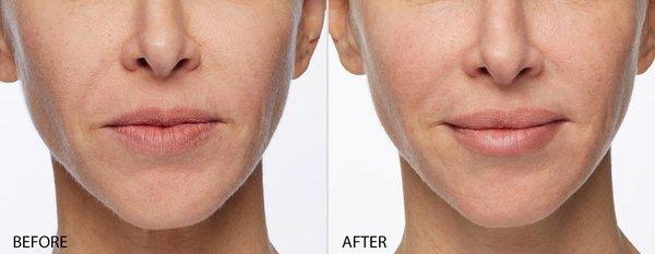 Restylane Lip Filler