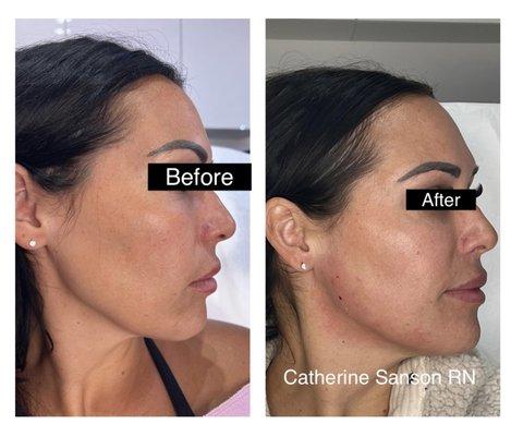 Dermal fillers to Temples, brow lift, high cheek jawline and chin