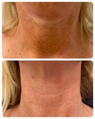 RF Microneedling after 2 treatments!