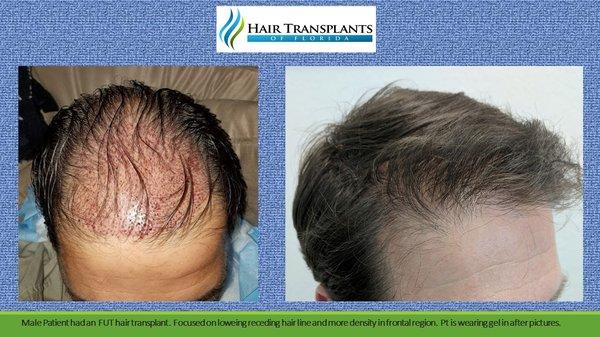 Patient had very aggressive hair loss.  Performed a 3000 graft procedure for front and mid areas...some in crown.