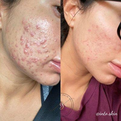 Before & After Blemish Buster Bootcamp