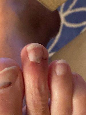 Same toe two days later after removing bandage.