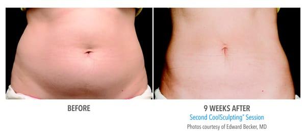 Now....offering Coolsculpting Fear no Mirror