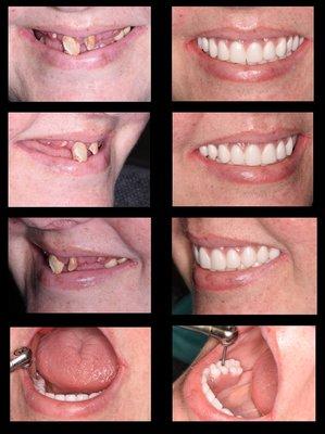 "All on X"...no more loose dentures!