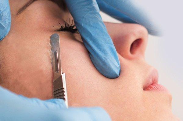 Dermaplaning