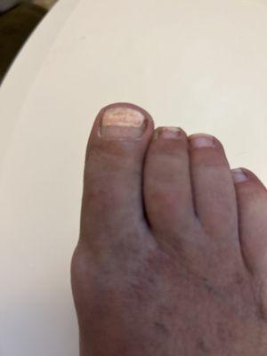 This is the nail fungus called Onychomycosis, that I got from the pedicure at J Nails and Spa!!