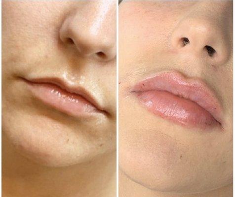 Lip filler