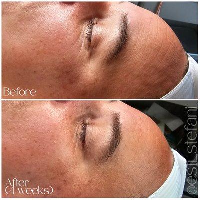 Microneedling before + after.