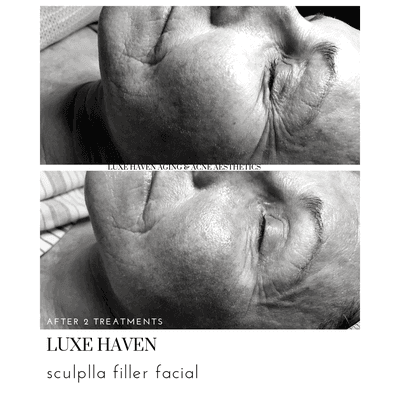 age correction without surgery. non-invasive facelift. no needle wrinkle treatments