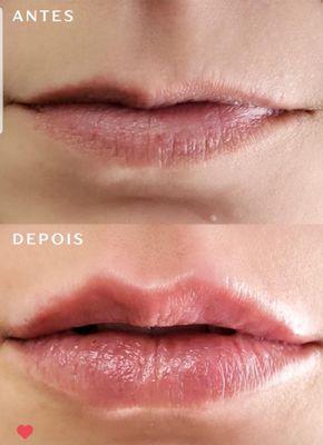 Before and after lip fillers. Come and get yours!