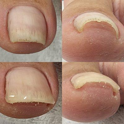 Ingrown toenail care