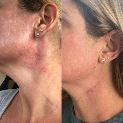 Before and after (one week post-procedure) - laser skin resurfacing. Still healing and will get even more impressive.