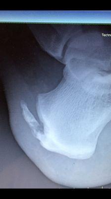 Large heel spur.