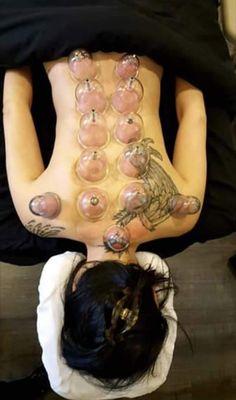 Cupping