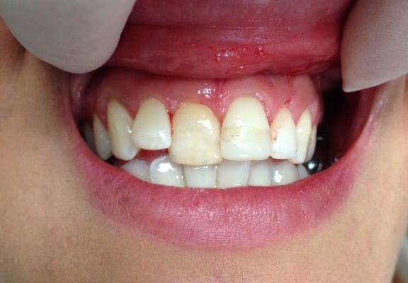 Before prepping tooth for Ceramic Crown