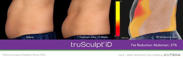 After just one treatment of truSculpt iD Body Sculpting