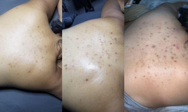 Acne back facials results