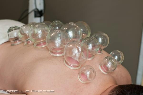 Cupping