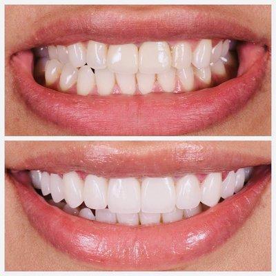 Smile makeover