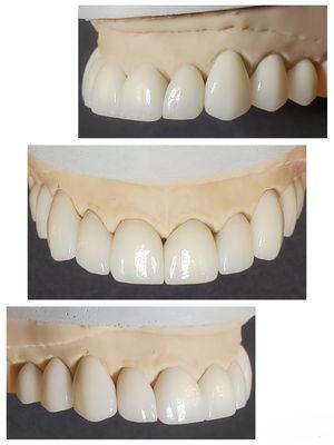 Porcelain veneers