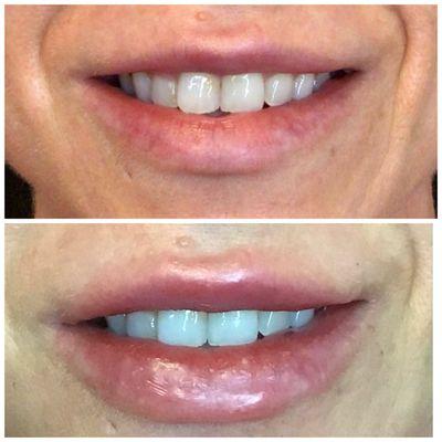 Lip Enhancement with Restylane Kysse