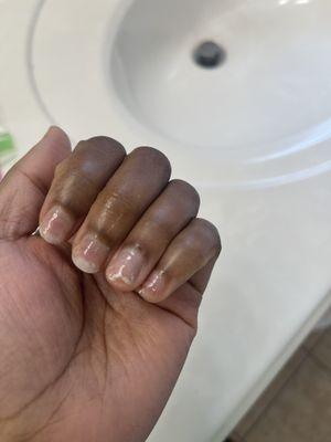 torn nails