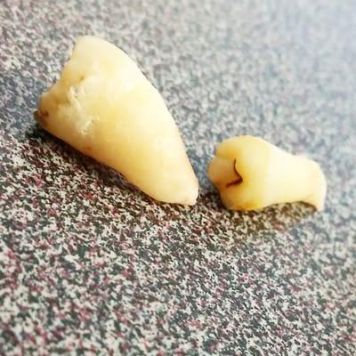 wisdom tooth removal