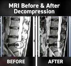 MRI Before & After Spinal Decompression