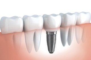 We offer dental implants. call us at 661-725-9105 for more information.