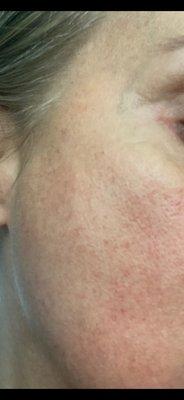 Skin catastrophe after one Laser Skin & Wellness Laser treatment.