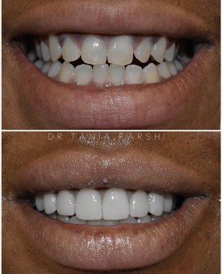 10 veneers!