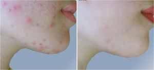 Acne Clearance (IPL Procedure - 3 to 4 sessions)