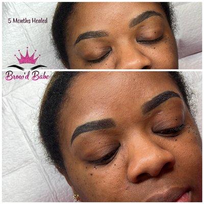 Healed Brow