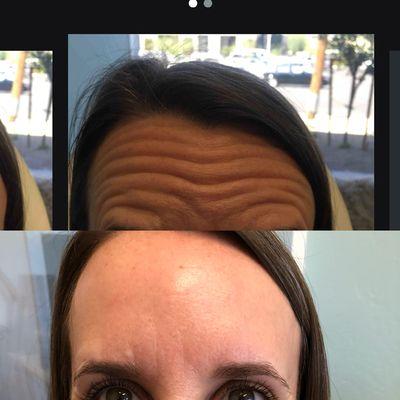 Botox to the forehead and glabella !