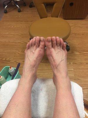 Feet getting callouses removed