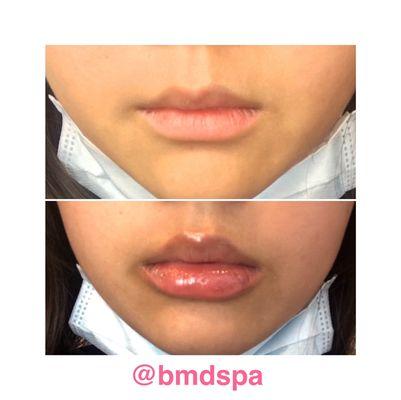 Before & After | Female | age:25 | Juvederm lip filler| 1 procedure | for this procedure 700, the price will vary depending on the client.