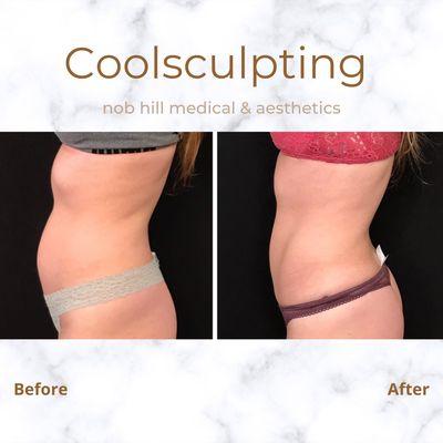 8 weeks after one session of Coolsculpting