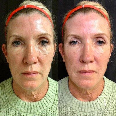 Undereye filler transformation