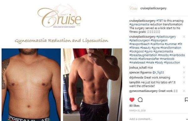 This patient was motivated to get in shape after having Gynecomastia surgery