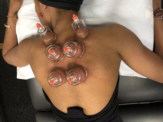 A favorite part of my therapy session ... cupping !!