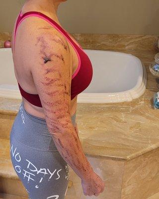 Dr Schneider burned and scarred me with her lack of knowledge with her IPL machine. #schneider #valerieschneider #drvalerieschneider