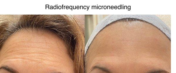 THis is RF Microneedling at its finest and NO botox!!!!