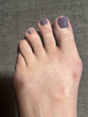 A really badly done pedicure