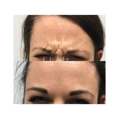 before and after wrinkle relaxer treatment!