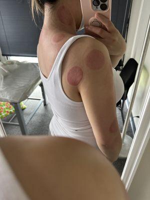 Post dynamic cupping