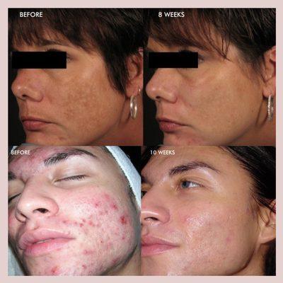 Dermal infusion facial treatment results