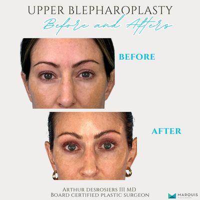 Upper blepharoplasty (upper eyelid lift) surgery for saggy eyelid skin