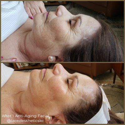 See beautiful results instantly with an Anti-Aging Facial