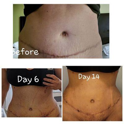 Post Lipo, Treatment with Claudia has helped me so much! Reaching each milestone with her recommendations.