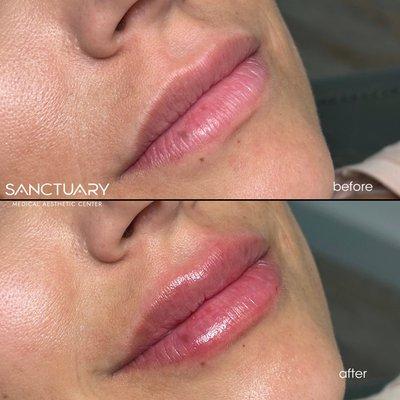 Before and after lip filler patient.